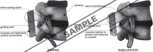 spine subluxation